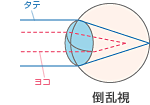 倒乱視の角膜の形.gif