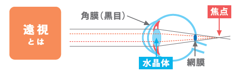 正視・近視・遠視・乱視について≪目が悪いとは？≫｜Menicon Miru 青葉台店｜コンタクトレンズ販売店のメニコンショップナビ