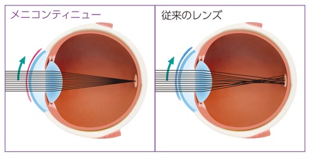 つけ心地が良い ハードレンズでも安心 快適 千葉のコンタクトレンズ Meniconmiru千葉c One店 メニコンミル千葉シーワン店 Menicon Miru 千葉 C One店 コンタクトレンズ販売店のメニコンショップナビ