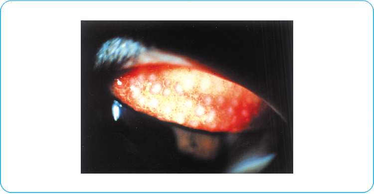 column09_img04  巨大乳頭結膜炎.png