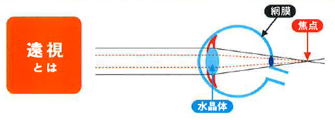 遠視とは1.png