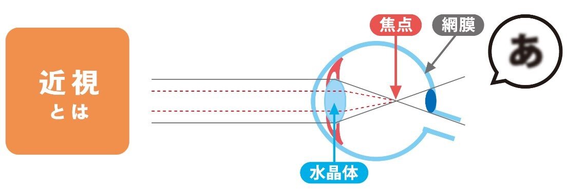 近視とは.jpg