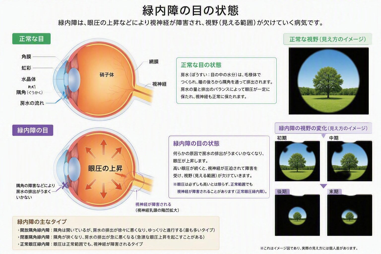 緑内障の図.jpg