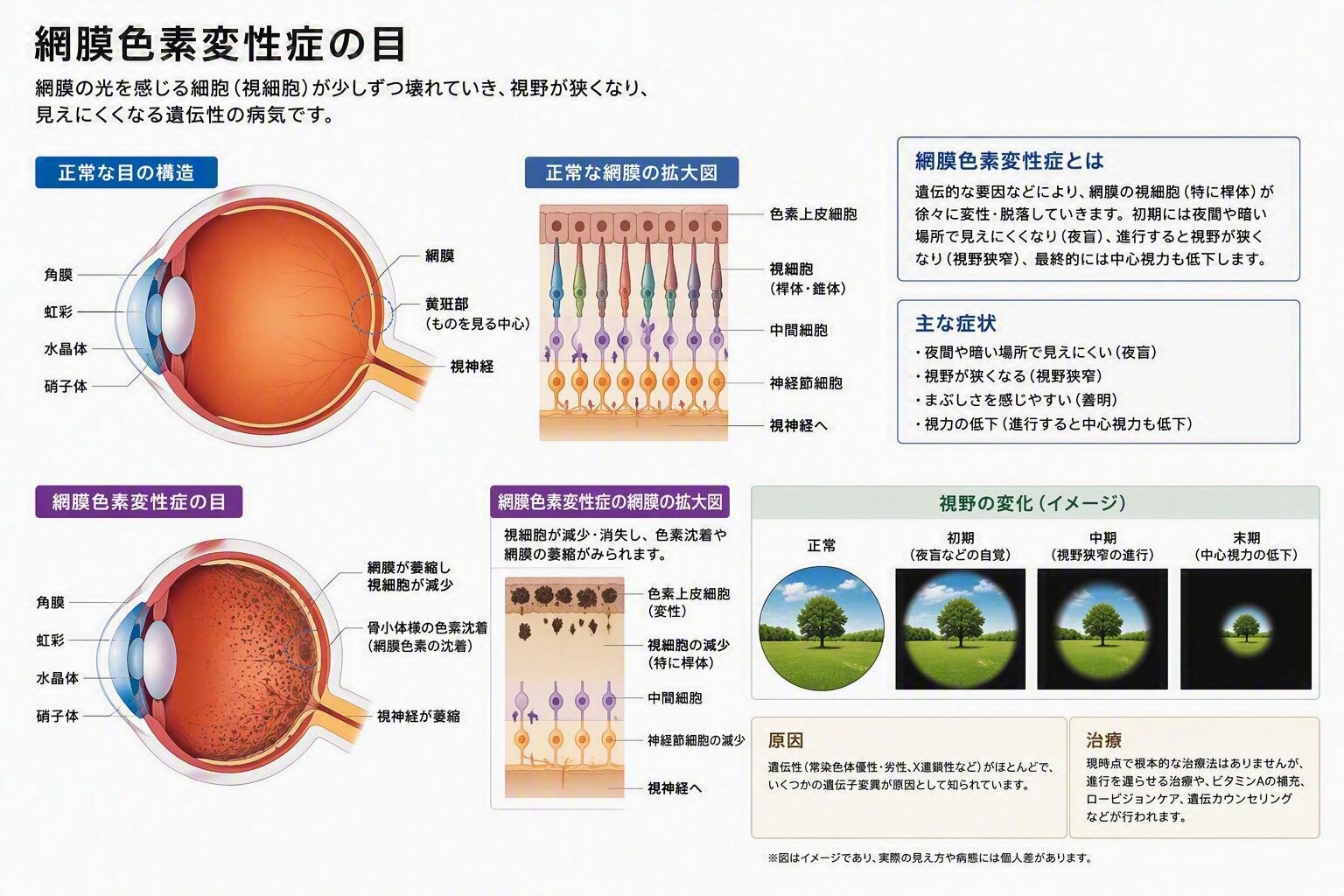 網膜色素変性症.jpg