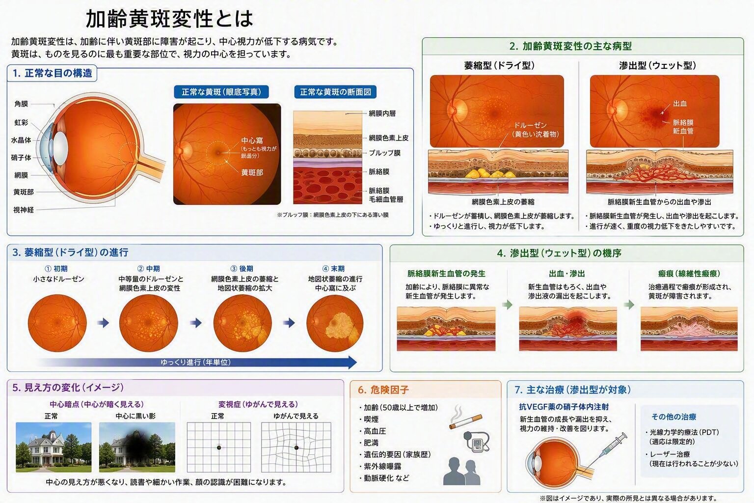 加齢黄斑変性.jpg