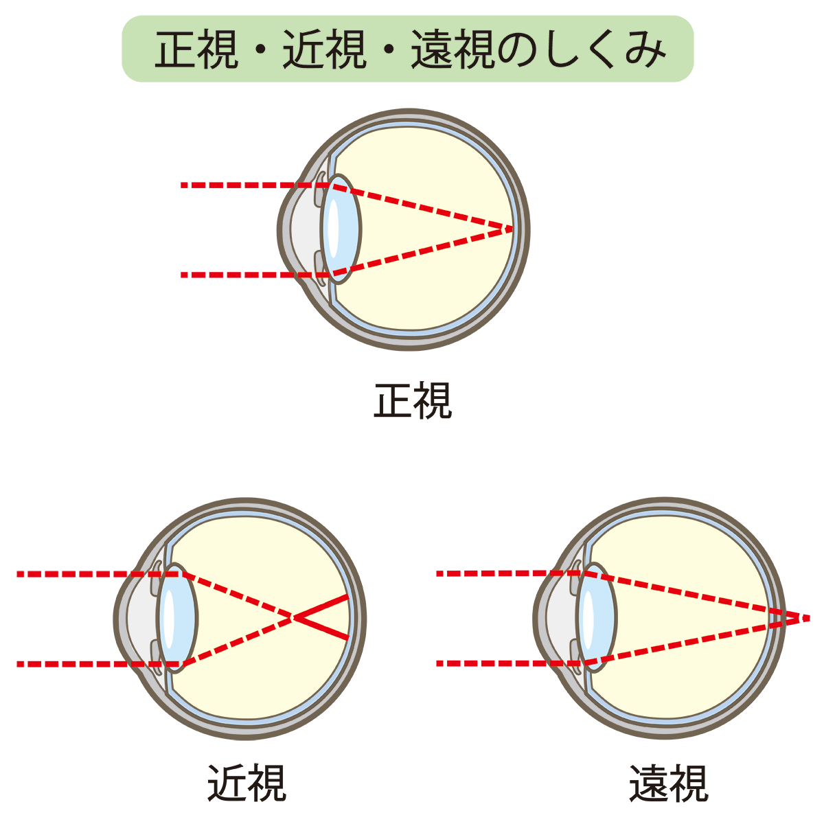 正視・近視・遠視の違い