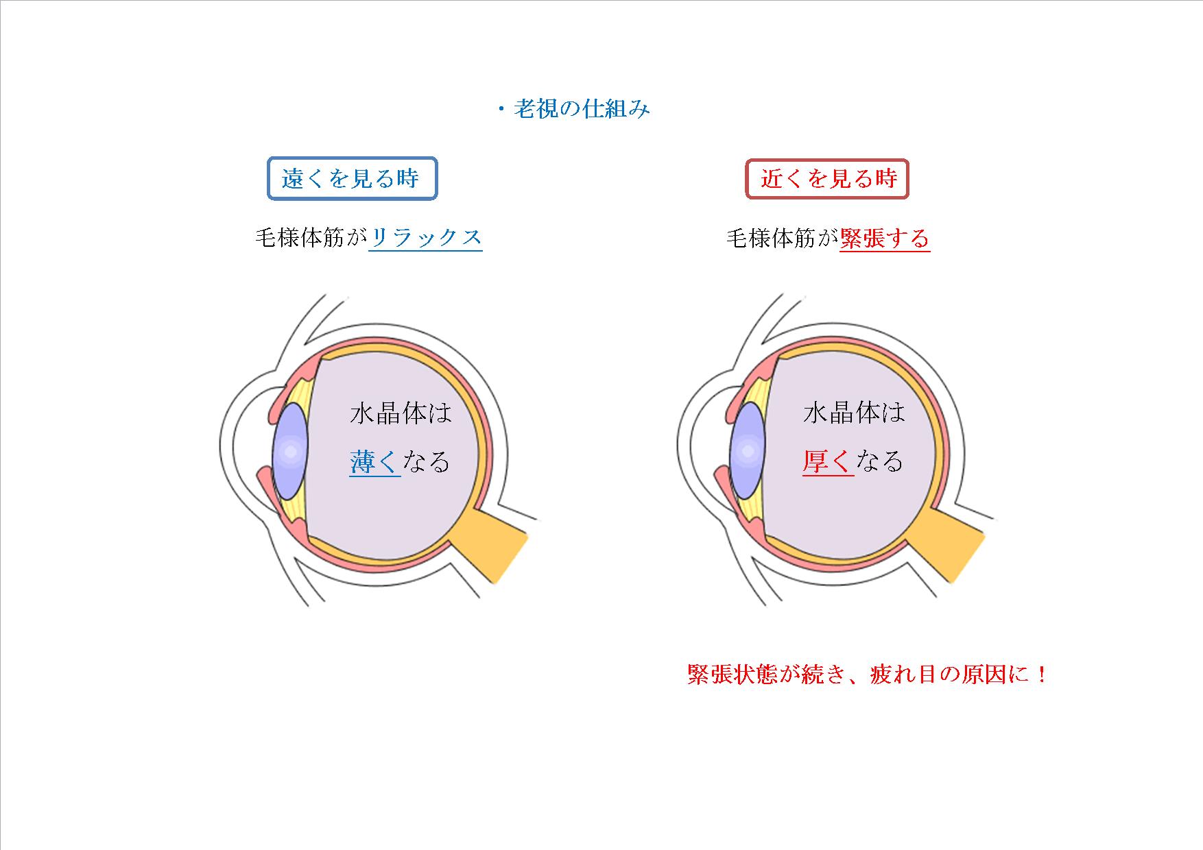 老眼とは何ですか?