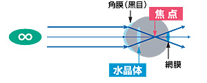 近視の見え方.jpg