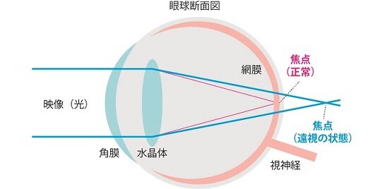 遠視の仕組み.jpg