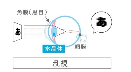 乱視画像.jpg